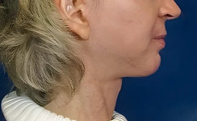 Chin Augmentation after surgery – Murrieta Facial Plastic Surgery, case 3