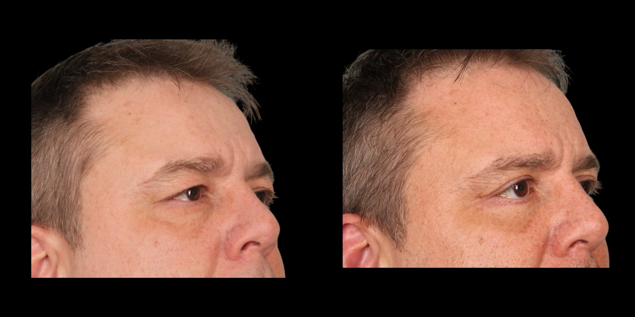 Blepharoplasty before-and-after composite, Consona Plastic Surgery – case 2, view 2