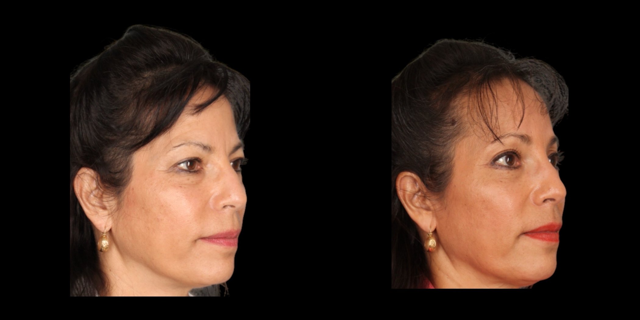 Blepharoplasty before-and-after composite, Consona Plastic Surgery – case 5, view 2