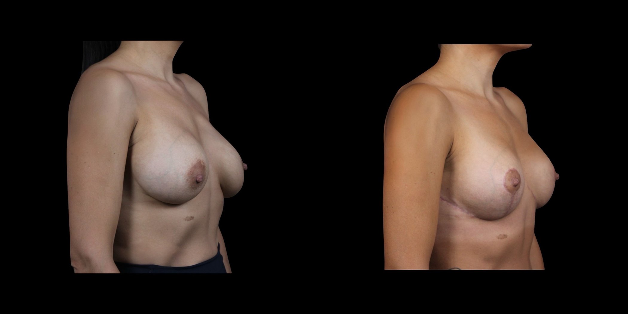 Augmentation Mastopexy before-and-after composite, Consona Plastic Surgery – case 1, view 2