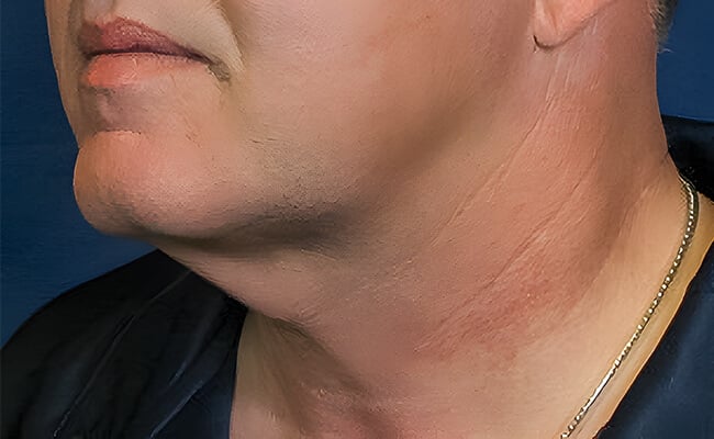Neck Lift before surgery – Murrieta Facial Plastic Surgery, case 2