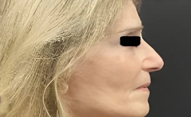 Facelift after surgery – Murrieta Facial Plastic Surgery, case 6