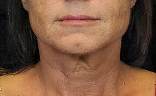 Neck Lift before surgery – Murrieta Facial Plastic Surgery, case 3