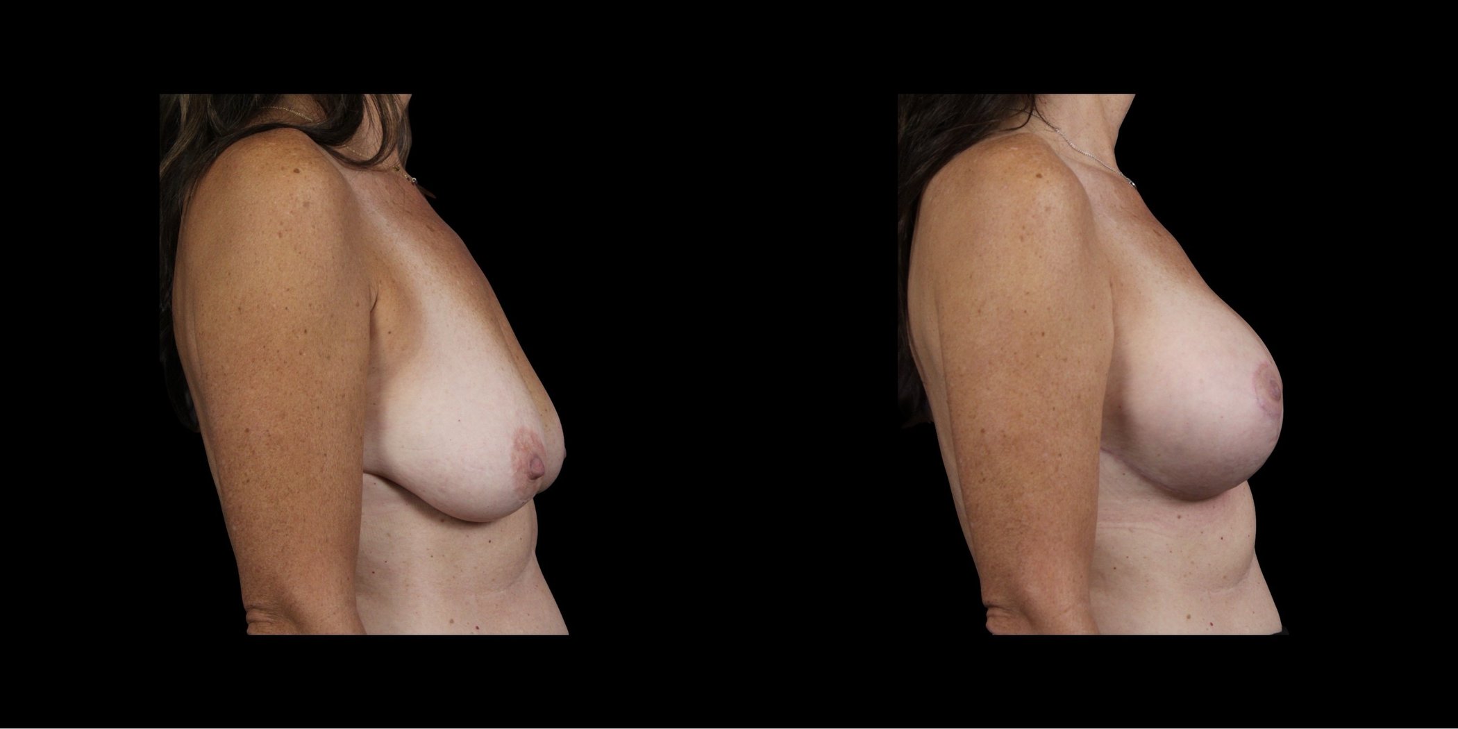 Augmentation Mastopexy before-and-after composite, Consona Plastic Surgery – case 5, view 3