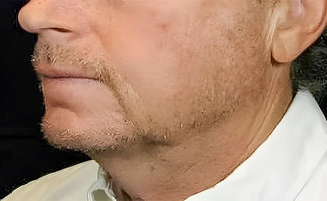 Facelift before surgery – Murrieta Facial Plastic Surgery, case 12