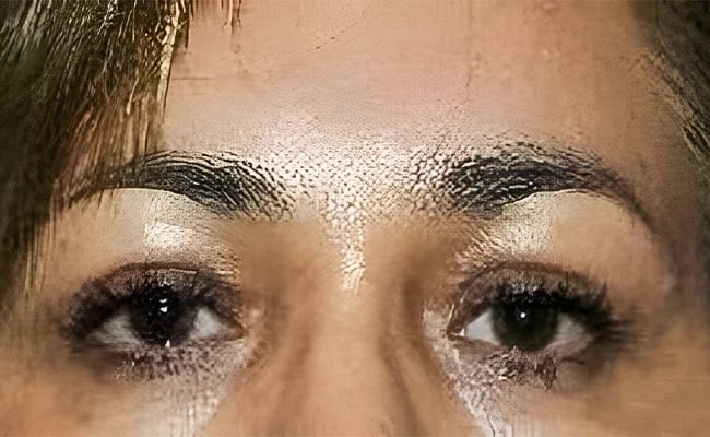 Brow Lift after surgery – Murrieta Facial Plastic Surgery, case 8