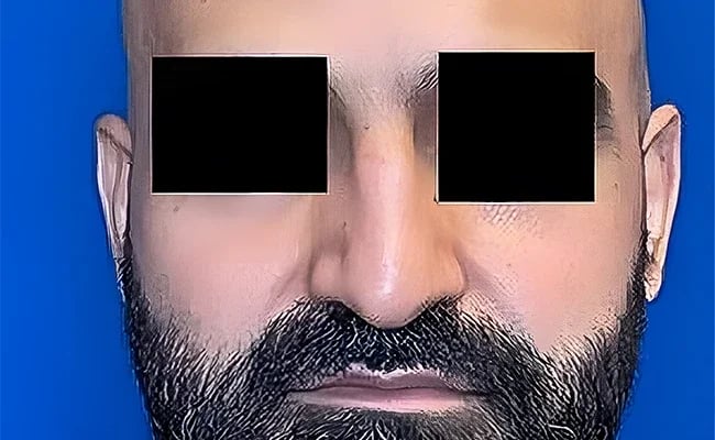 Rhinoplasty before surgery – Murrieta Facial Plastic Surgery, case 17