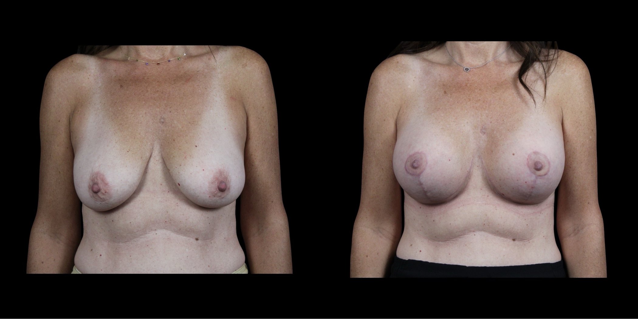 Augmentation Mastopexy before-and-after composite, Consona Plastic Surgery – case 5, view 1