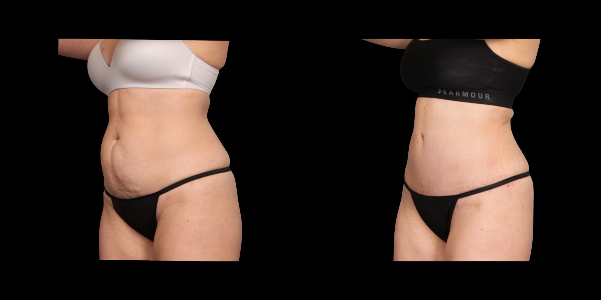 Abdominoplasty before-and-after composite, Consona Plastic Surgery – case 3, view 2