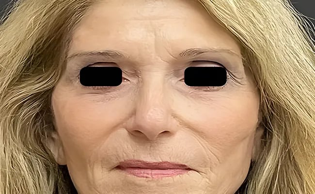 Brow Lift after surgery – Murrieta Facial Plastic Surgery, case 6