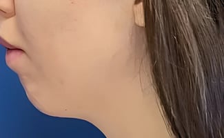 Chin Augmentation before surgery – Murrieta Facial Plastic Surgery, case 1