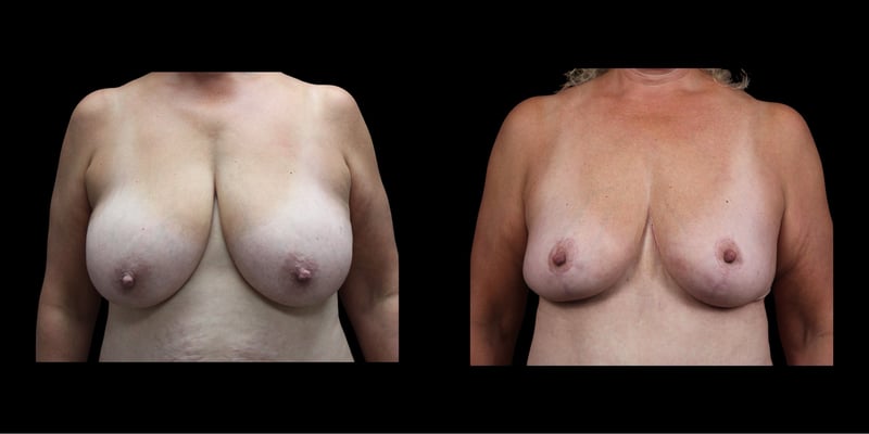 Breast Lift before-and-after composite, Consona Plastic Surgery – case 1, view 1