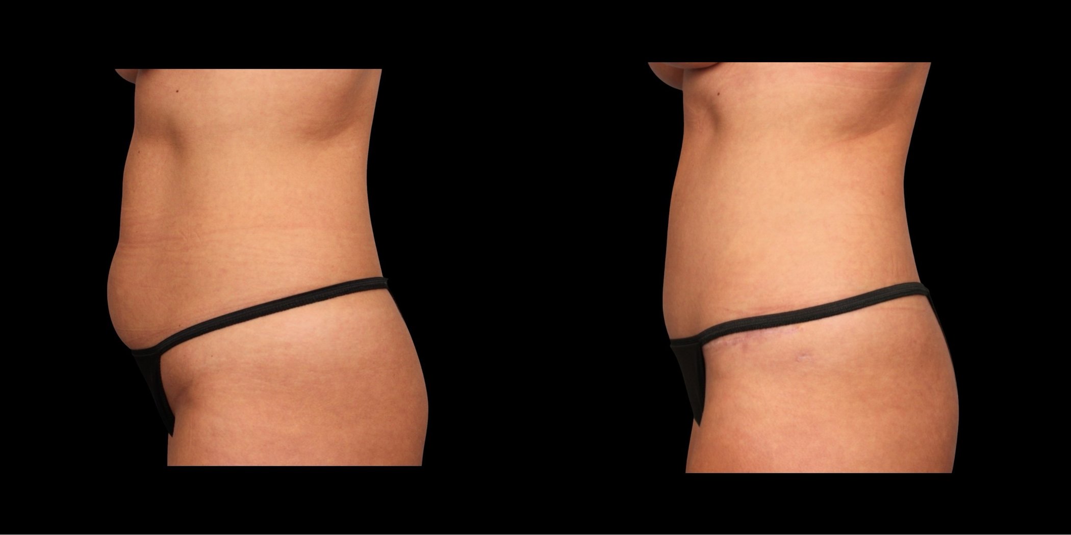 Abdominoplasty before-and-after composite, Consona Plastic Surgery – case 1, view 3