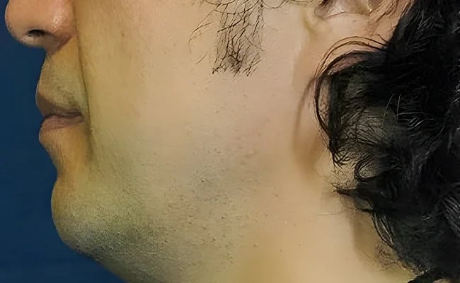 Chin Augmentation before surgery – Murrieta Facial Plastic Surgery, case 7