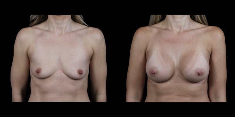 Breast Augmentation before-and-after composite, Consona Plastic Surgery – case 2, view 1