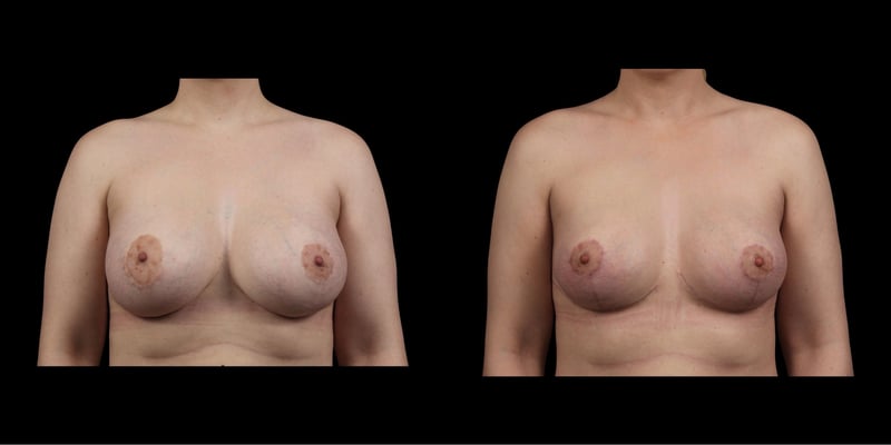 Augmentation Mastopexy before-and-after composite, Consona Plastic Surgery – case 3, view 1