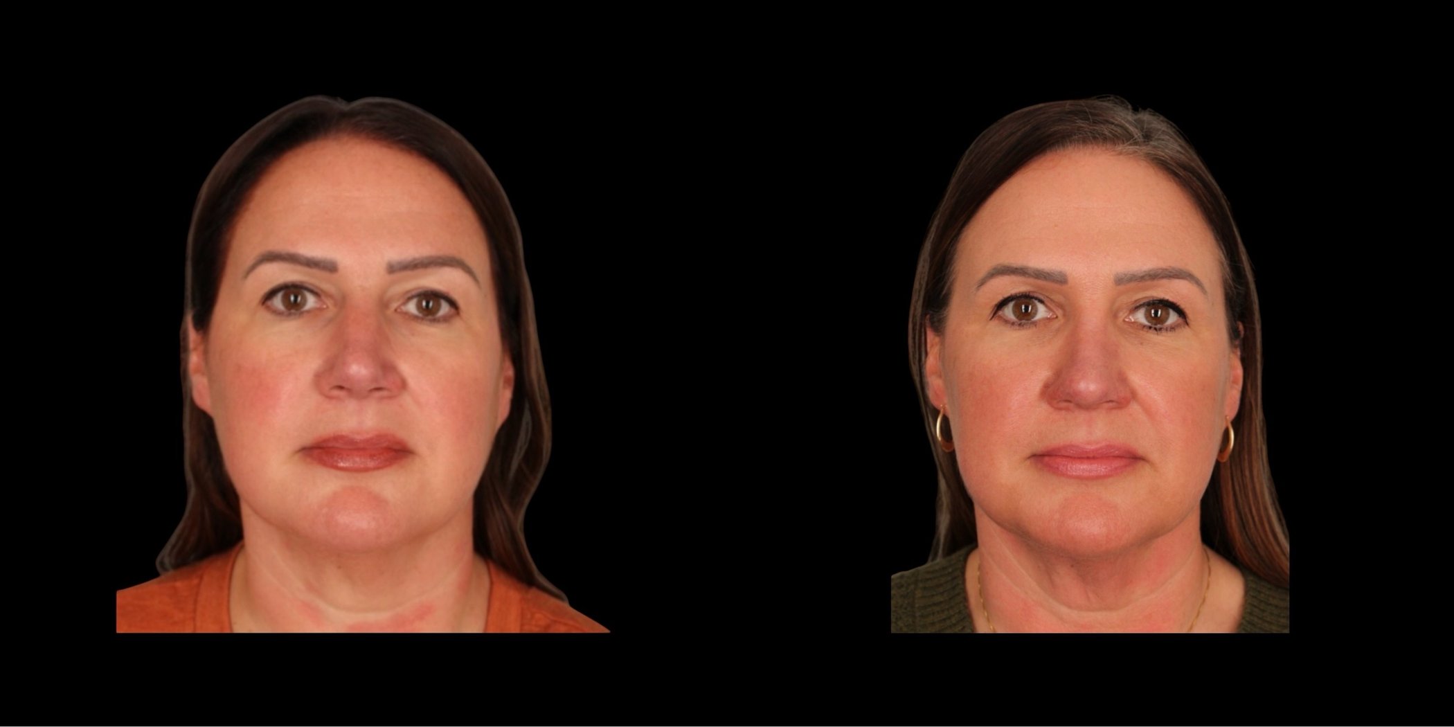 Rhinoplasty before-and-after composite, Consona Plastic Surgery – case 5, view 1