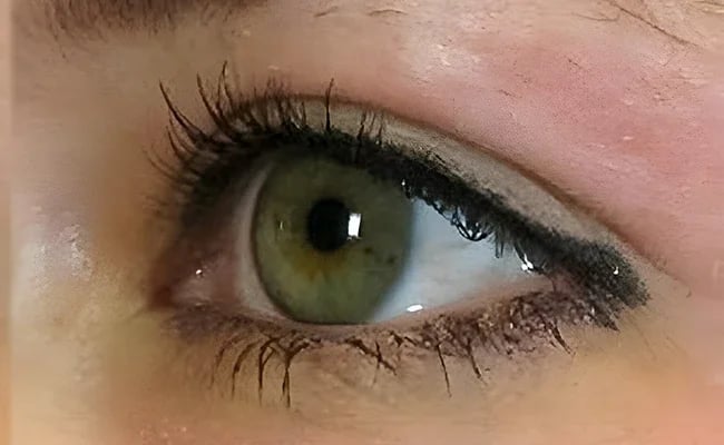 Eyelid Surgery after surgery – Murrieta Facial Plastic Surgery, case 12