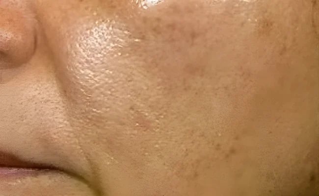 Facial Fat Grafting before surgery – Murrieta Facial Plastic Surgery, case 3