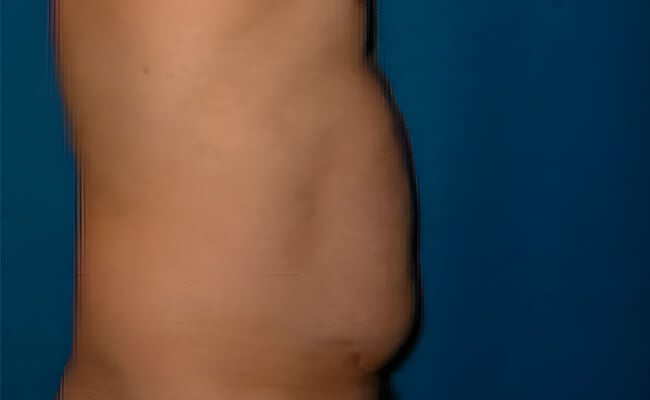 Liposuction before surgery – Murrieta Facial Plastic Surgery, case 5