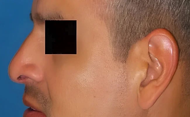 Rhinoplasty after surgery – Murrieta Facial Plastic Surgery, case 16