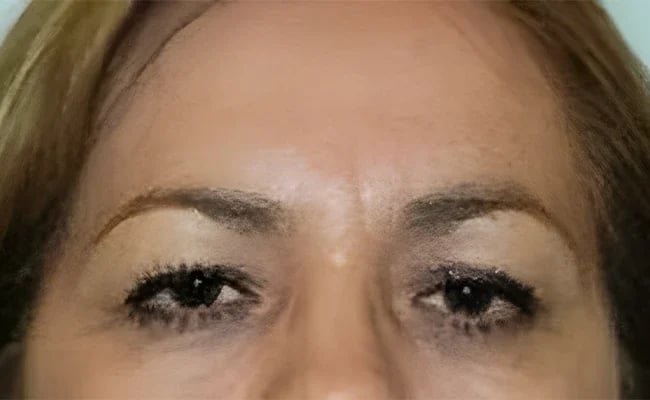 Brow Lift before surgery – Murrieta Facial Plastic Surgery, case 8