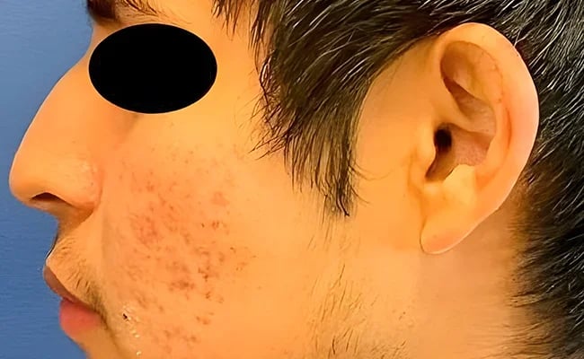 Rhinoplasty before surgery – Murrieta Facial Plastic Surgery, case 12