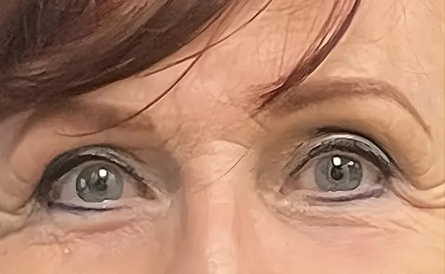 Brow Lift after surgery – Murrieta Facial Plastic Surgery, case 1