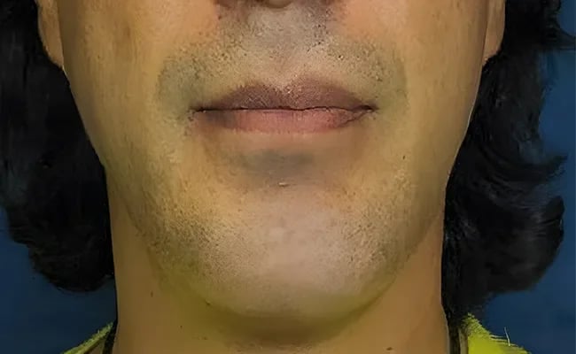 Chin Augmentation after surgery – Murrieta Facial Plastic Surgery, case 6