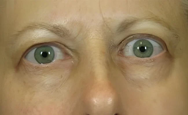 Eyelid Surgery before surgery – Murrieta Facial Plastic Surgery, case 16