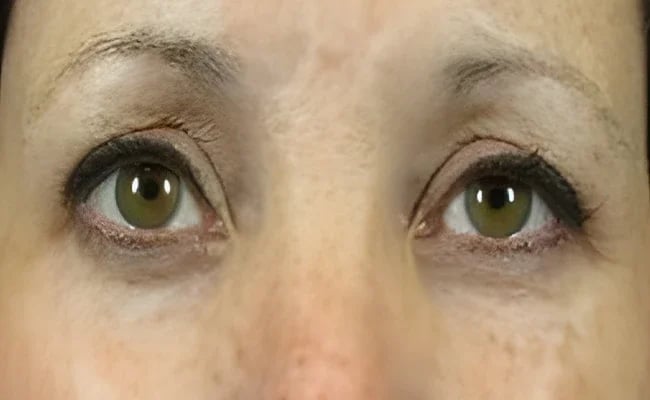 Eyelid Surgery before surgery – Murrieta Facial Plastic Surgery, case 22