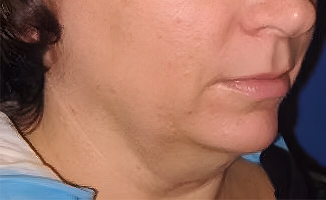 Neck Lift before surgery – Murrieta Facial Plastic Surgery, case 7