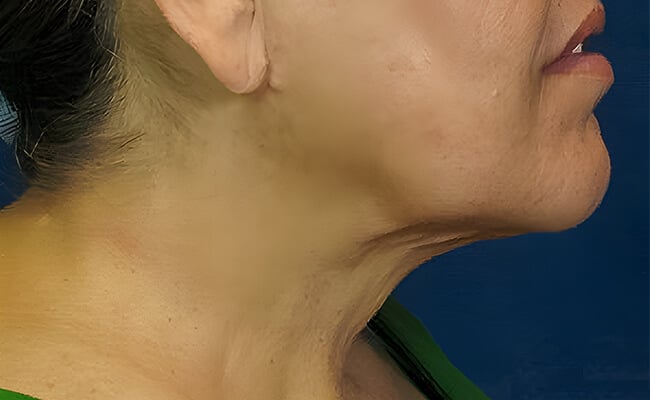 Neck Lift after surgery – Murrieta Facial Plastic Surgery, case 1