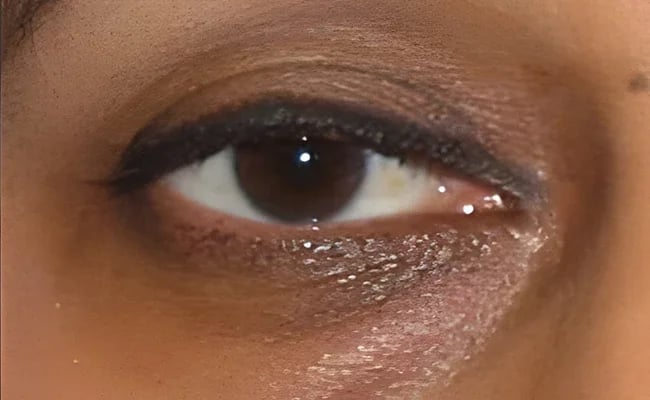 Eyelid Surgery before surgery – Murrieta Facial Plastic Surgery, case 18