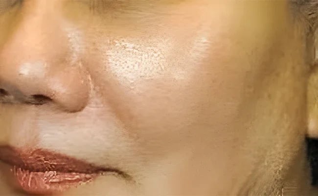 Facial Fat Grafting after surgery – Murrieta Facial Plastic Surgery, case 2