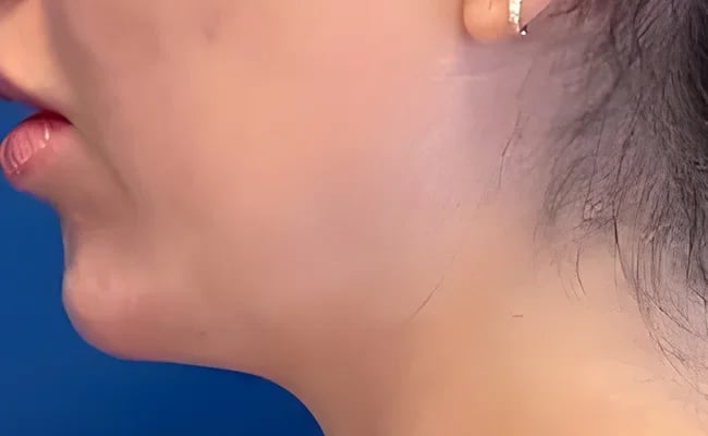 Chin Augmentation after surgery – Murrieta Facial Plastic Surgery, case 1