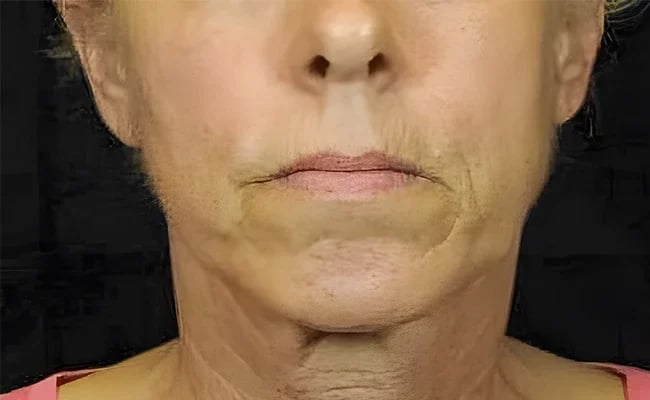 Facelift before surgery – Murrieta Facial Plastic Surgery, case 8