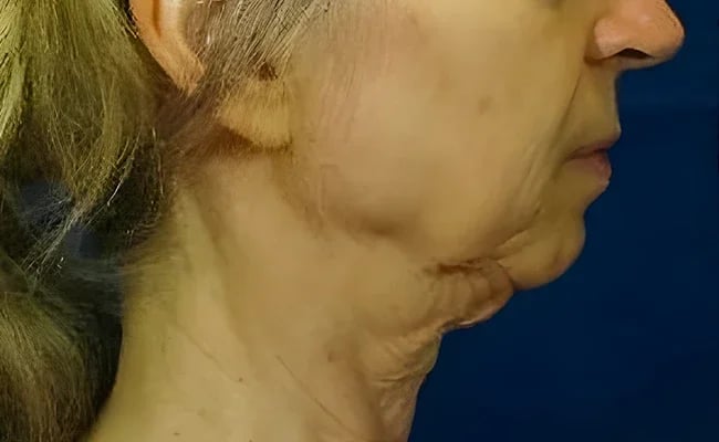 Facelift before surgery – Murrieta Facial Plastic Surgery, case 15