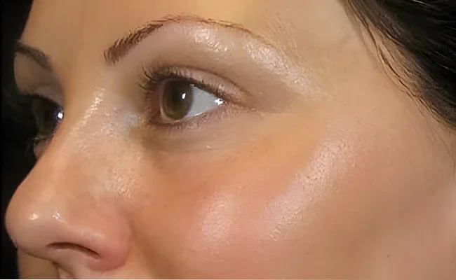 Facelift after surgery – Murrieta Facial Plastic Surgery, case 22
