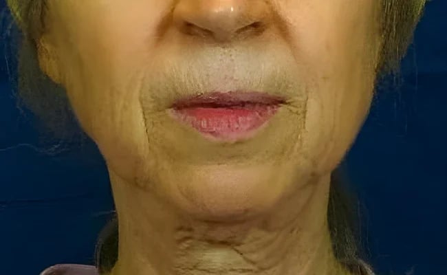 Chin Augmentation before surgery – Murrieta Facial Plastic Surgery, case 2