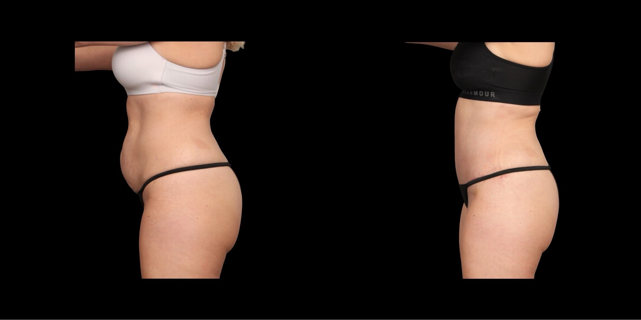 Abdominoplasty before-and-after composite, Consona Plastic Surgery – case 3, view 3