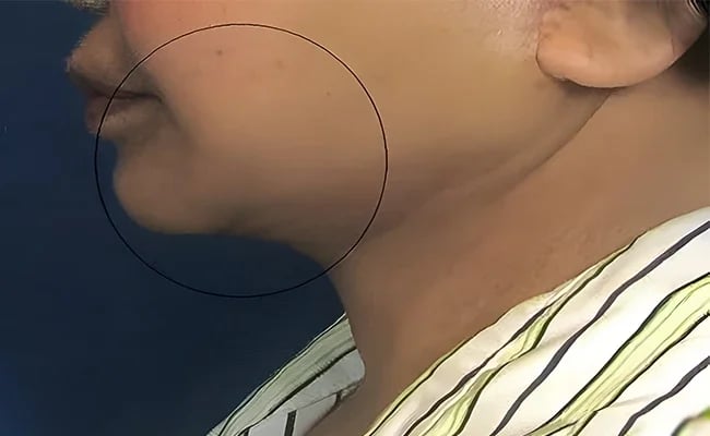 Facelift after surgery – Murrieta Facial Plastic Surgery, case 27