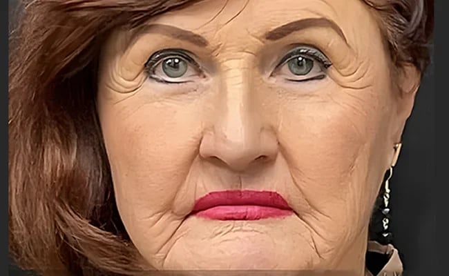 Facelift before surgery – Murrieta Facial Plastic Surgery, case 24