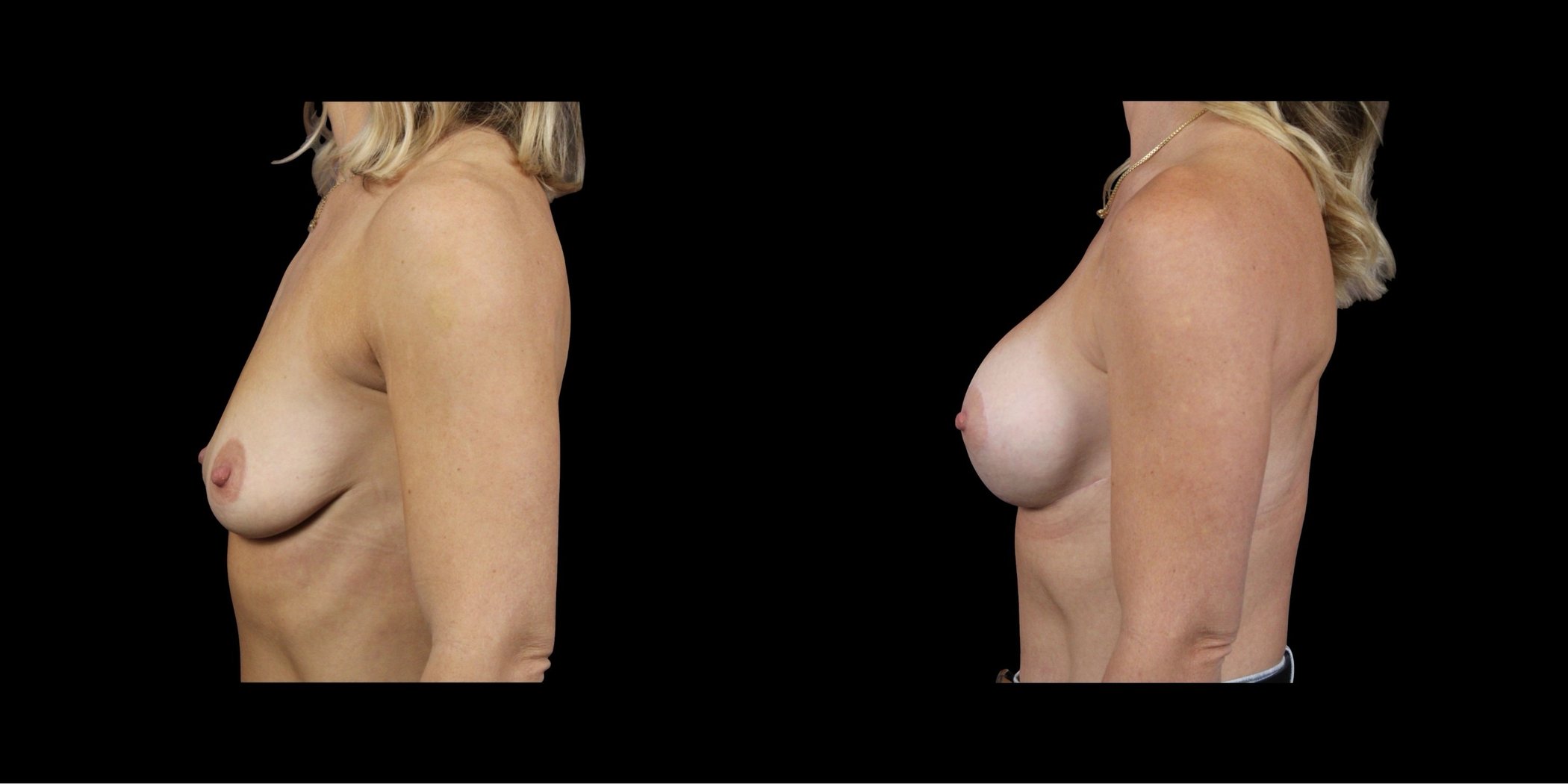 Augmentation Mastopexy before-and-after composite, Consona Plastic Surgery – case 6, view 3