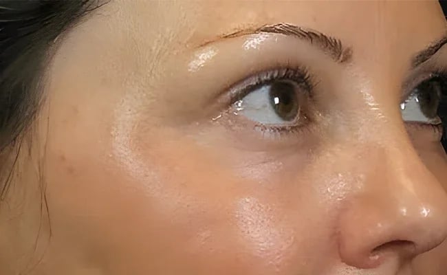 Facelift after surgery – Murrieta Facial Plastic Surgery, case 21