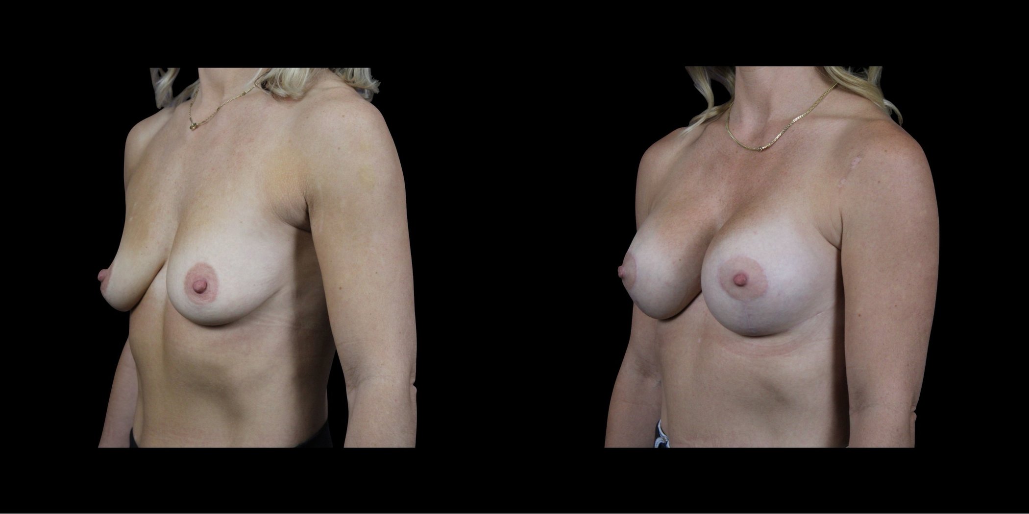 Augmentation Mastopexy before-and-after composite, Consona Plastic Surgery – case 6, view 2