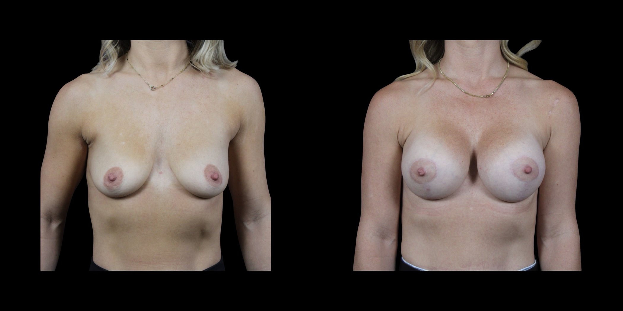 Augmentation Mastopexy before-and-after composite, Consona Plastic Surgery – case 6, view 1
