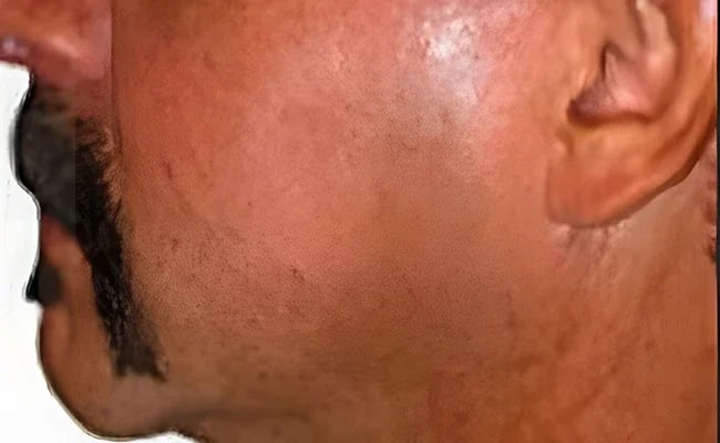 Chin Augmentation after surgery – Murrieta Facial Plastic Surgery, case 5