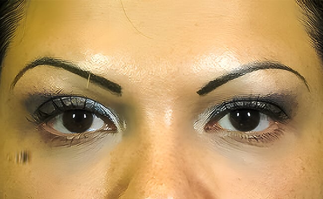 Vampire Facelift after treatment – Murrieta Facial Plastic Surgery, case 1
