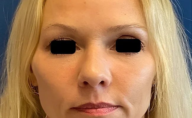 Rhinoplasty after surgery – Murrieta Facial Plastic Surgery, case 5